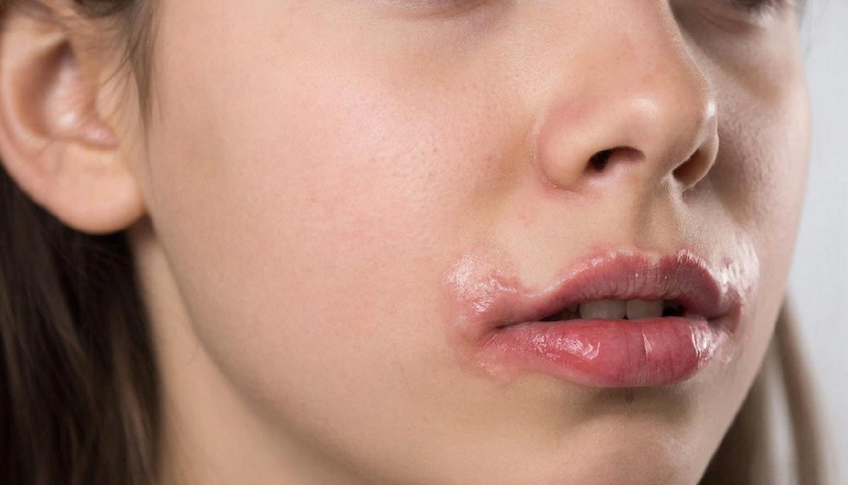 Почему просыпается «спящий» вирус: эксперт Пироговского Университета об опоясывающем герпесе фото: Почему просыпается «спящий» вирус: эксперт Пироговского Университета об опоясывающем герпесе