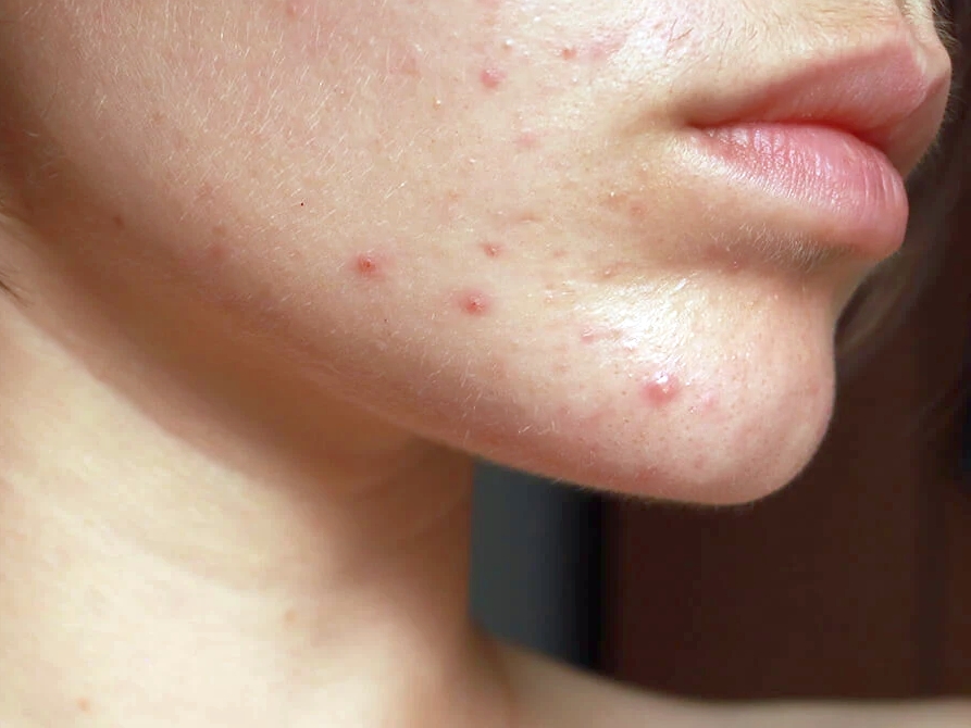 фото: Life.ru выяснил неочевидные способы борьбы с прыщами