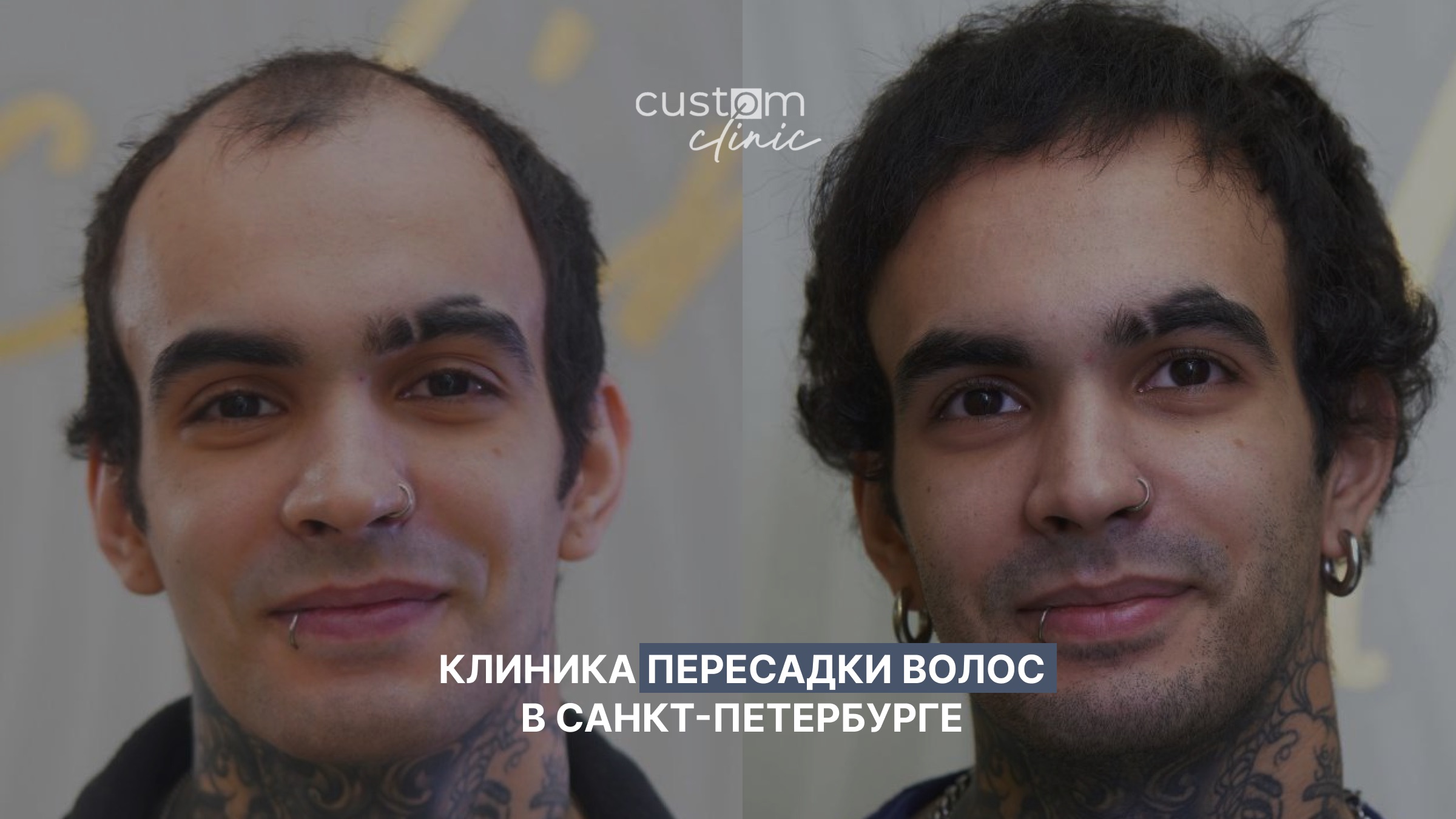 фото: Custom Clinic - это клиника в центре Санкт-Петербурга, где решают проблему выпадения волос комплексно и эффективно