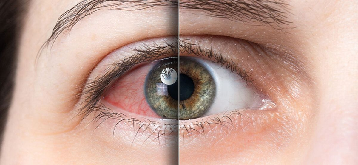 Красные глаза: косметический дефект или повод для тревоги?