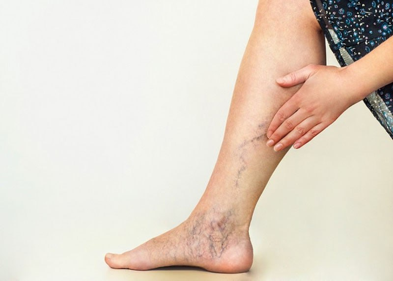 фото: Когда вены не справляются: что усугубляет венозную недостаточность