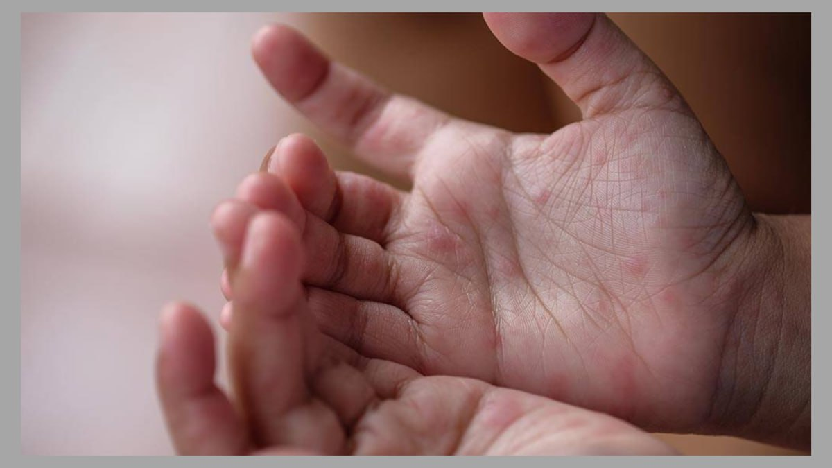 Что нужно знать о вирусе Коксаки: пути заражения и профилактика