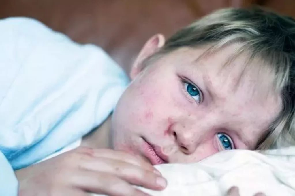 Эксперт Пироговского Университета: — о симптомах кори и вакцинации