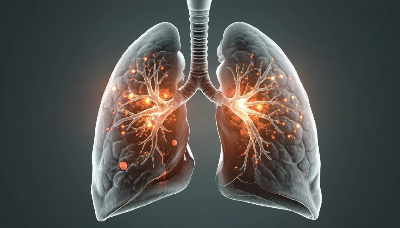 фото: Туберкулез: врач Пироговского Университета о путях заражения, защите детей и первых симптомах