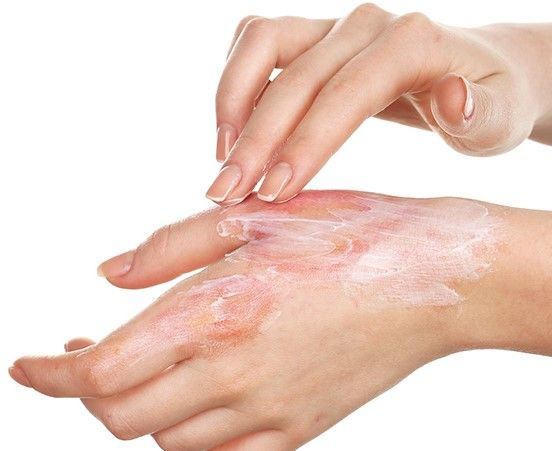 фото: Ожоги: инструкция по спасению без ошибок