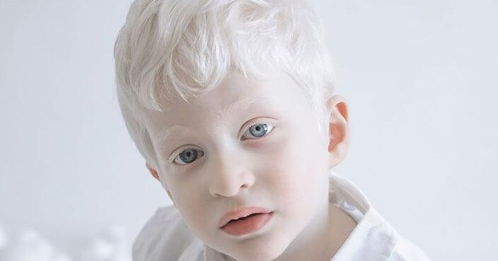 фото: Солнце, зрение, кожа: главные проблемы людей с альбинизмом